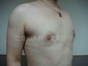 男性女乳手術