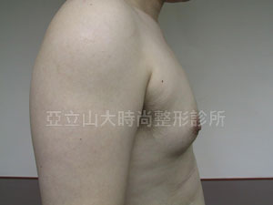 男性女乳手術