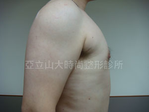 男性女乳手術