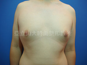 男性女乳手術