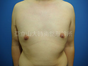 男性女乳手術
