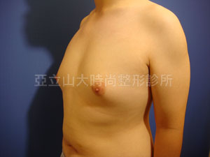 男性女乳手術