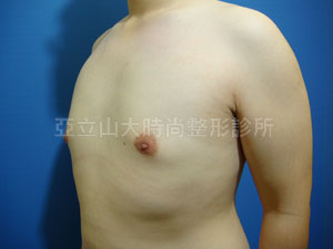 男性女乳手術