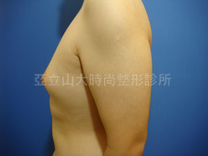 男性女乳手術
