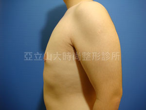 男性女乳手術