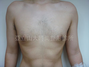 男性女乳手術
