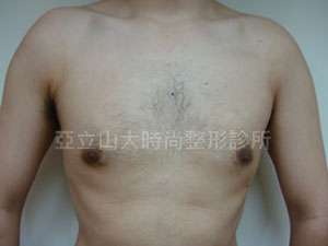 男性女乳手術