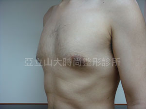 男性女乳手術