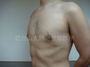 男性女乳手術