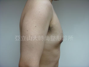 男性女乳手術