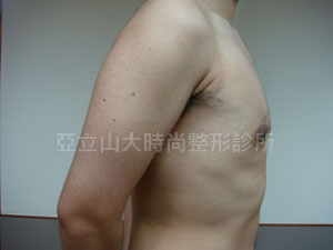 男性女乳手術