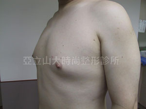 男性女乳手術
