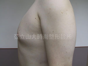 男性女乳手術