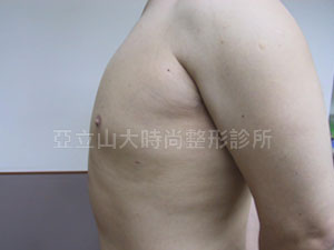 男性女乳手術