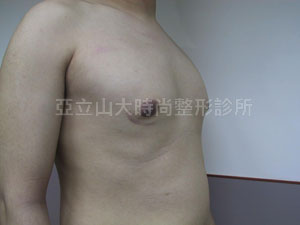 男性女乳手術