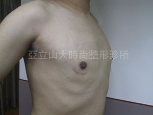 男性女乳手術