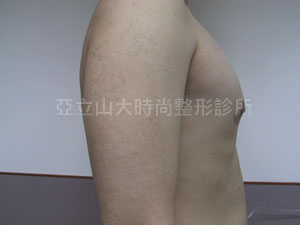 男性女乳手術