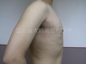 男性女乳手術