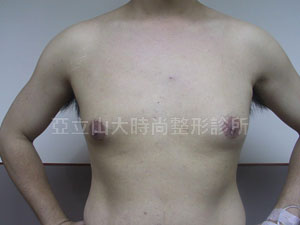 男性女乳手術