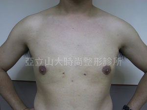 男性女乳手術