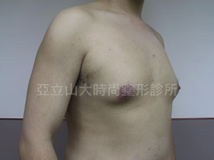 男性女乳手術