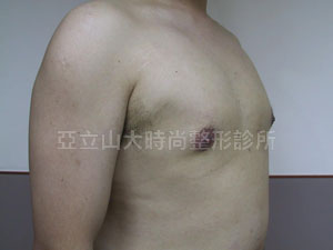 男性女乳手術