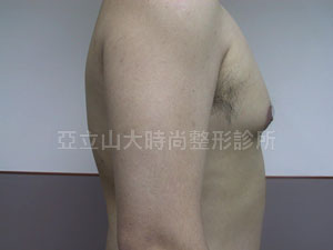 男性女乳手術