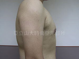 男性女乳手術