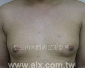 男性女乳手術
