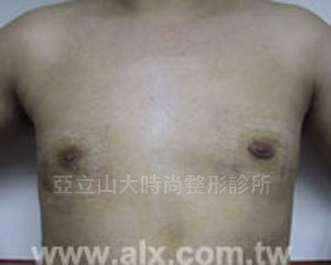 男性女乳手術
