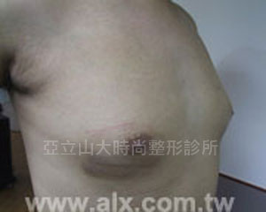 男性女乳手術