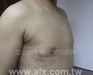 男性女乳手術